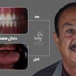 نمونه کار دندان مصنوعی 30