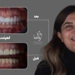 نمونه کار لمینت دندان کلینیک زندیه 40