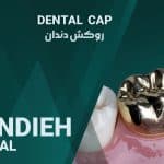 نمونه کار روکش دندان 13
