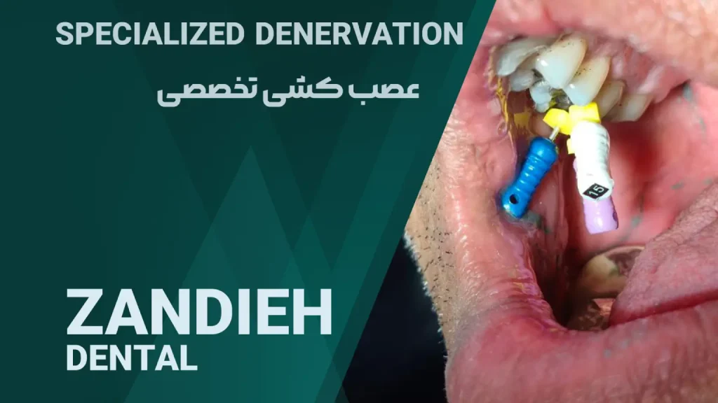 عصب کشی تحصصی و ترمیم دندان در شیراز
