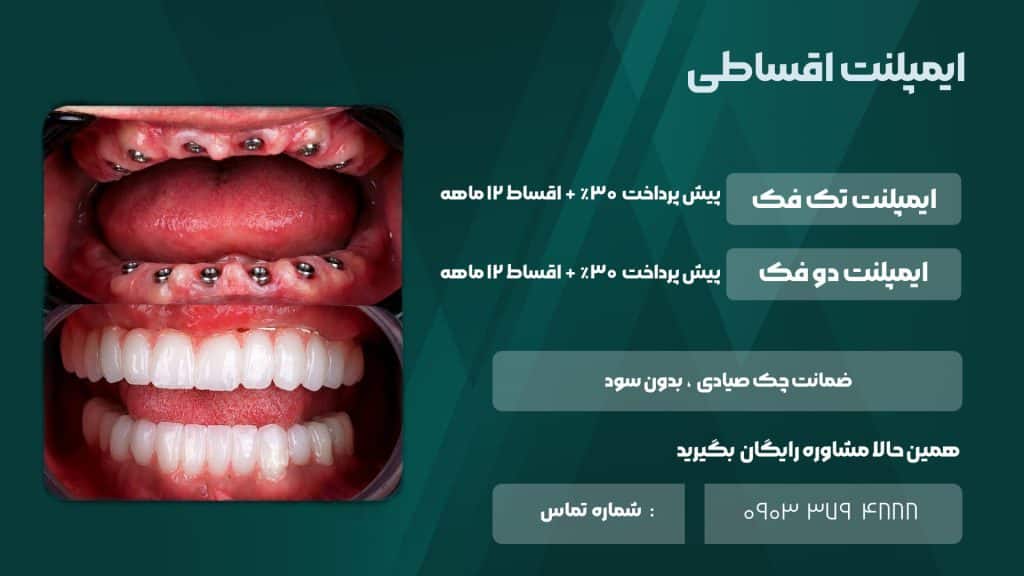 شرایط اقساط ایمپلنت دندان کلینیک زندیه شیراز