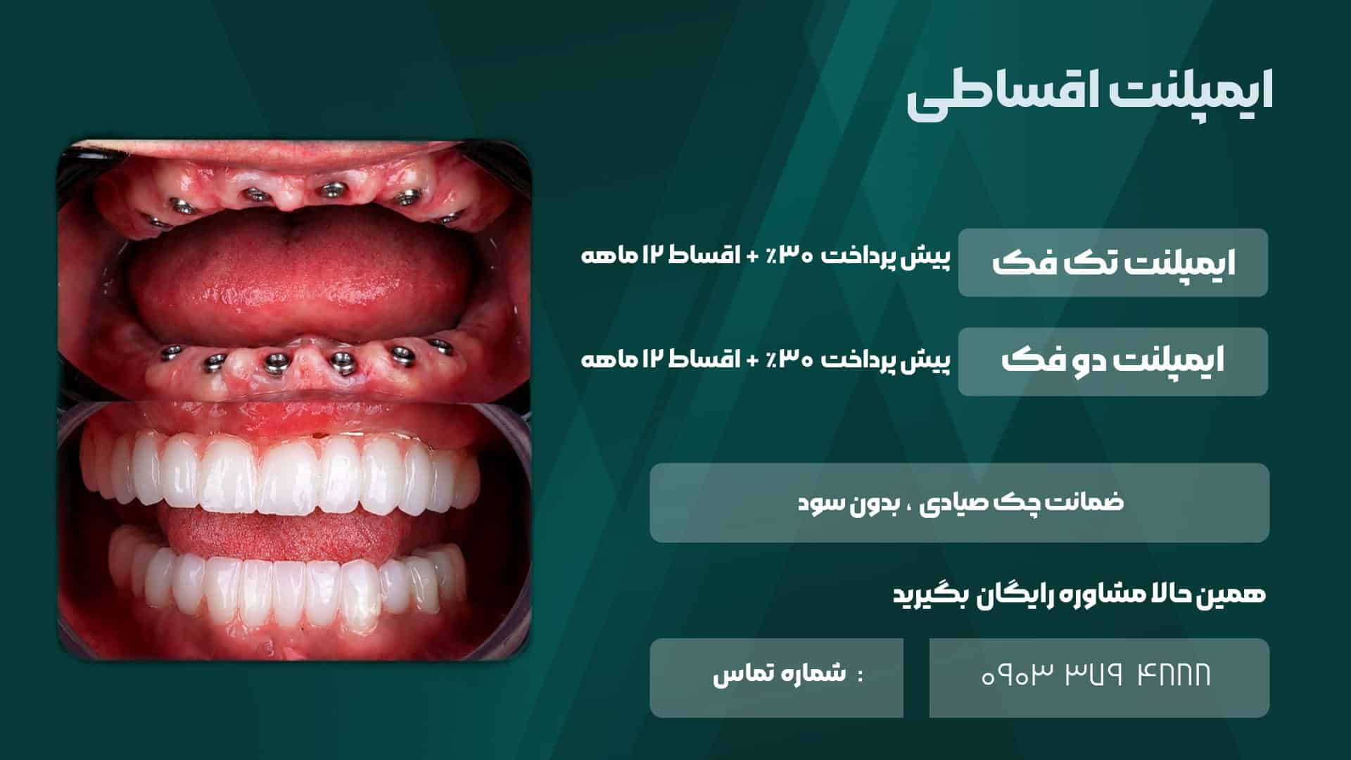 شرایط اقساط ایمپلنت دندان کلینیک زندیه شیراز