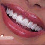 نمونه کار کامپوزیت لیرینگ کلینیک زندیه 109