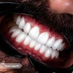 نمونه کار کامپوزیت لیرینگ کلینیک زندیه 110