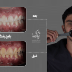 نمونه کار بلیچینگ دندان 034