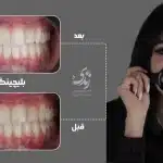 نمونه کار بلیچینگ دندان 035