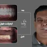 نمونه کار ایمپلنت دندان 032