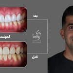 نمونه کار لمینت دندان کلینیک زندیه 42