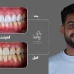 نمونه کار لمینت دندان کلینیک زندیه 41