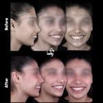 نمونه کار ارتودنسی کلینیک زندیه 57